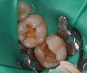 Courtesy of Dr Barry Crowley. Composite restoration